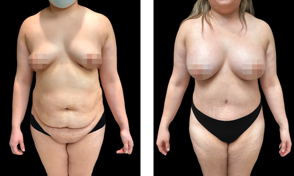 Mommy Makeover - The Mommy Makeover is ideal for mothers seeking to restore confidence and improve body image. This procedure is practical and offers long-lasting results. It is particularly beneficial for those who desire a perkier, youthful bust or fuller breasts, as well as a flatter, firmer abdomen or an enhanced hourglass figure. Mommy Makeover - The Mommy Makeover is ideal for mothers seeking to restore confidence and improve body image. This procedure is practical and offers long-lasting results. It is particularly beneficial for those who desire a perkier, youthful bust or fuller breasts, as well as a flatter, firmer abdomen or an enhanced hourglass figure.