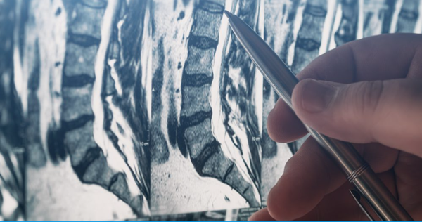 Analgesic Discograms - A discogram is a procedure performed to determine the origin of a patient’s pain. Tears and disruptions within the disc are made visible to the fluoroscopy by the application of a contrast dye. This method is generally used to determine if disc pain is the predominant source of a patient’s back pain. Conventional discograms accomplish this by provoking pain by creating pressure in the target joint. An analgesic discogram differs by using a local anesthetic to deaden the pain. This avoids overpressurizing the disc and causing the patient discomfort while still obtaining valuable information about their condition. This is why Pain Management Services uses analgesic discograms preferentially when diagnosing discogenic pain.

An analgesic discogram is scheduled when a damaged or compromised disc is suspected to be a potential source of your pain. The procedure will begin with you being placed face down on an operating table. Pillows will be placed in a manner that supports your lower back. This area is then cleaned, sterilized, and draped prior to the application of a local topical anesthetic. An additional injection of local anesthetic will be applied to the treatment area to further ease discomfort.

Once the anesthetic has taken hold, a spinal needle will be inserted into the disc under the guidance of a fluoroscopy machine. This specialized x-ray machine makes it possible to visualize the placement of the needle and ensure it reaches the target area successfully.
Once in place, the catheter will be used to administer the local anesthetic to the target disc.
The needle is subsequently removed, and you will be asked to pay attention to your pain for the next couple of hours.
During this time, you may be asked to perform activities that would aggravate your pain. These actions can include bending or sitting.
You’ll be asked to keep a pain diary to describe how your back pain reacted to the anesthetic over the course of the rest of the day.
 
This procedure is generally fairly comfortable for the patient. There is rarely a cause for any significant amount of sedation. This is part of what makes it preferable to a conventional discography. An IV sedative may be provided for those who are anxious. If you are given this option, a driver will be needed after the procedure to bring you home.

Prior to the procedure, it’s important that you avoid using blood thinners or anti-coagulation for the recommended amount of time. The patient’s physician managing these medications must give approval to stop these medications. A specific plan will have to be worked out if you are on any of these medications to avoid complications from sudden cessation of these medications. If you are receiving an IV sedation, then you will have to avoid eating for eight hours prior to the appointment.