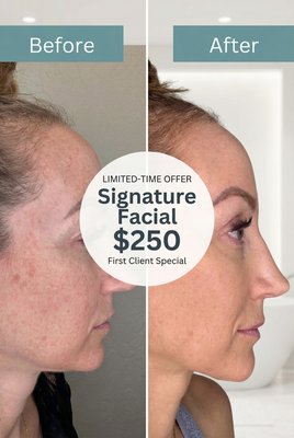 Signature Stem Cell Facial - Our Signature Stem Cell Facial at Needle & Silk Aesthetics is a luxury, nurse-led skin rejuvenation treatment using Procell microchanneling with medical-grade stem cells and growth factors. This advanced facial helps improve texture, tone, fine lines, acne scarring, and overall skin health with minimal downtime. Each treatment is fully customized for your skin goals.