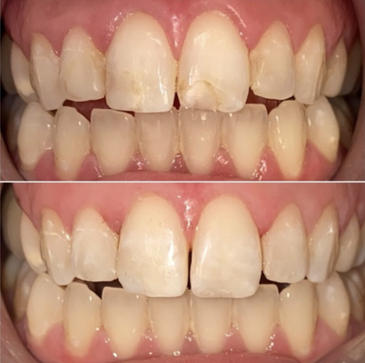 Composite Bondings - Composite Bonding cases