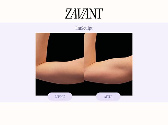 EmSculpt - Explore EmSculpt before & after results at Zavant Aesthetics. EmSculpt is a non-surgical body sculpting treatment that uses advanced muscle stimulation to strengthen, tone, and define targeted areas.
Treatment can target areas including the abdomen, buttocks, arms, thighs, and calves. Each EmSculpt plan is personalized based on anatomy, muscle tone, treatment area, and body goals. EmSculpt - Explore EmSculpt before & after results at Zavant Aesthetics. EmSculpt is a non-surgical body sculpting treatment that uses advanced muscle stimulation to strengthen, tone, and define targeted areas.
Treatment can target areas including the abdomen, buttocks, arms, thighs, and calves. Each EmSculpt plan is personalized based on anatomy, muscle tone, treatment area, and body goals.