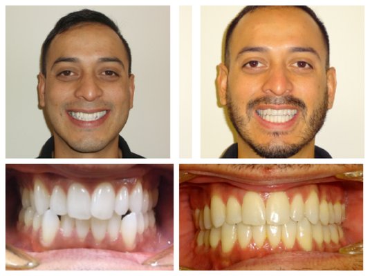 Invisalign Treatment - Patients treated with Invisalign by Dr Beroukhim DDS, Board Certifed Orthodontist. Invisalign Treatment - Patients treated with Invisalign by Dr Beroukhim DDS, Board Certifed Orthodontist.