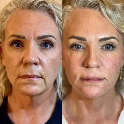 Full Facial Balancing - ✨ Facial Balancing – Before & After
This patient came to us seeking a more refreshed, confident look without changing her natural features. Our expert injector performed a full facial balancing treatment using strategic dermal filler placement in the cheeks, chin, and lips, with a touch of neurotoxin to soften expression lines.

The result? Subtle, lifted contours, improved facial symmetry, and a rejuvenated overall appearance — all while preserving the unique character of her face. No overfilling. No guesswork. Just harmony, structure, and natural confidence.

Every face tells a story. Facial balancing ensures it reads exactly how you want it to.
