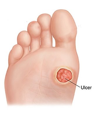 Foot and Ankle Surgery - We are board certified foot and ankle surgeons specializing in fractures/trauma, tendon issues, sprains, bunions, hammer toes, flat feet, wound care and limb salvage, nerve disorders of the foot and ankle.  Dr. Wittenberg is board certified in foot surgery by ABFAS (the American Board of Foot & Ankle Surgeons) as well as by ABLES/ABMSP (the American Board of Lower Extremity Surgeon currently under the American Board of Multiple Specialties in Podiatry).  With 24 years of experience and the highest level of ethics and patient care, there is noone in Las Vegas with as much experience or as high quality of care in the Las Vegas Valley for your foot and ankle needs.