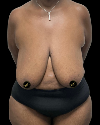 Breast Lift - This patient was suffering from back pain, ill-fitting clothes, and activity restrictions due to her large, ptotic breasts. She is now a whole new person and love her results! Breast Lift - This patient was suffering from back pain, ill-fitting clothes, and activity restrictions due to her large, ptotic breasts. She is now a whole new person and love her results!