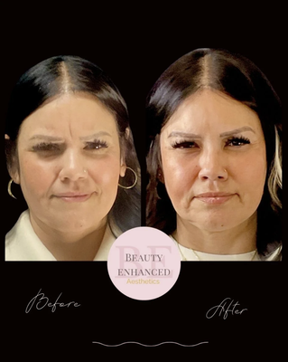 Botox Before / After - Botox before / after Botox Before / After - Botox before / after
