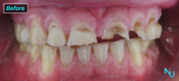 Top Arch Reconstruction - Before and After Images of a Top Arch Mouth Reconstruction Performed at Nu Dentistry.
