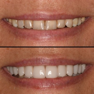 Cosmetic Dental Work - Before and after photos of veneers Cosmetic Dental Work - Before and after photos of veneers