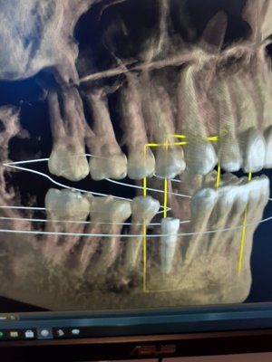 CBCT SCAN - Cone-beam computed tomography systems (CBCT) are a variation of traditional computed tomography (CT) systems. The CBCT systems used by dental professionals rotate around the patient, capturing data using a cone-shaped X-ray beam. CBCT SCAN - Cone-beam computed tomography systems (CBCT) are a variation of traditional computed tomography (CT) systems. The CBCT systems used by dental professionals rotate around the patient, capturing data using a cone-shaped X-ray beam.