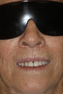 Esthetic Bonding - Closing the "black triangles" between teeth due to gum recession. Esthetic Bonding - Closing the "black triangles" between teeth due to gum recession.