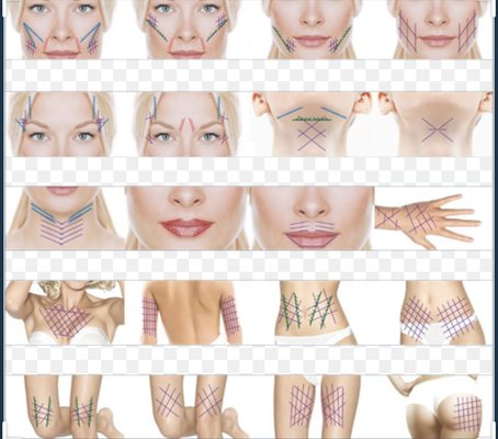 PDO THREAD NON SURGICAL FACE LIFT - Pdo threads are a great option if you are looking to pull and tack back the skin from aging. Prevention is also a key measure while collagen is stimulated over time with pdo threads PDO THREAD NON SURGICAL FACE LIFT - Pdo threads are a great option if you are looking to pull and tack back the skin from aging. Prevention is also a key measure while collagen is stimulated over time with pdo threads