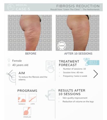 Body Conturing - THE MOST POPULAR TREATMENTS
Light legs. Designed to boost blood and lymphatic circulation, this treatment gives your legs an immediate feeling of lightness and well-being. (Pregnancy, edema, jetlag)
Face stimulation. A treatment for a complete face and neck stimulation. After a few minutes, your skin will look toned and silky and your face more radiant and youthful.
Skin regeneration. Treatment to promote tissue oxygenation and skin regeneration. (icoone 80 or 120min facials)
Skin toning. A full body treatment, to look more slim and toned. (60/90/120 min lymphatic drainage massages)
Cellulite and fat reduction. A treatment to reduce the appearance of cellulite. This treatment remodels your entire figure, while giving you a pleasant feeling of well-being. Body Conturing - THE MOST POPULAR TREATMENTS
Light legs. Designed to boost blood and lymphatic circulation, this treatment gives your legs an immediate feeling of lightness and well-being. (Pregnancy, edema, jetlag)
Face stimulation. A treatment for a complete face and neck stimulation. After a few minutes, your skin will look toned and silky and your face more radiant and youthful.
Skin regeneration. Treatment to promote tissue oxygenation and skin regeneration. (icoone 80 or 120min facials)
Skin toning. A full body treatment, to look more slim and toned. (60/90/120 min lymphatic drainage massages)
Cellulite and fat reduction. A treatment to reduce the appearance of cellulite. This treatment remodels your entire figure, while giving you a pleasant feeling of well-being.