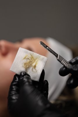 Demaplaning - We will manually exfoliate the treatment area using a 10-gauge scalpel. Vellus hair (AKA peach fuzz) is also removed during the treatment. The immediate result is fresh, bright skin revealed and a smoother look and feel. In addition, removing dead skin cells and vellus hair creates a smooth foundation for cosmetic application and skincare products will better penetrate the skin. This treatment comes with good deep cleanse, custom enzyme exfoliation and vitamin infusion under recovering mask and LED lights. (50 min) Demaplaning - We will manually exfoliate the treatment area using a 10-gauge scalpel. Vellus hair (AKA peach fuzz) is also removed during the treatment. The immediate result is fresh, bright skin revealed and a smoother look and feel. In addition, removing dead skin cells and vellus hair creates a smooth foundation for cosmetic application and skincare products will better penetrate the skin. This treatment comes with good deep cleanse, custom enzyme exfoliation and vitamin infusion under recovering mask and LED lights. (50 min)