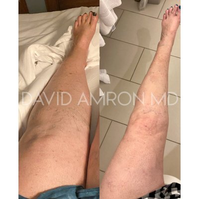 Lipedema - Some women just can’t seem to lose weight even with an ideal regimen of diet & exercise. Until recently this has been a lingering mystery they have just had to live with. But there is an answer with Dr. Amron's Advanced Lipedema Treatment program.
Rarely talked about, the disorder known as Lipedema has affected 17 million in the United States and 370 million worldwide. A vast majority of the individuals affected by this disorder are women.
This chronic disorder affects the legs and arms, causing an abnormal accumulation of fat cells and producing a noticeably disproportionate appearance. This condition not only causes emotional distress but is also very painful and potentially debilitating. Lipedema is commonly misdiagnosed as weight gain or lymphedema.
Lipedema strikes both thin and obese individuals alike, and generally no amount of diet or exercise can cease or prevent it. This disorder typically becomes present in an individual’s teenage years and then becomes progressively worse. However, Dr. David Amron, who has focused his 27+ year career on liposuction, has found success for his lipedema patients through his specialized multi-step circumferential liposuction technique. Lipedema - Some women just can’t seem to lose weight even with an ideal regimen of diet & exercise. Until recently this has been a lingering mystery they have just had to live with. But there is an answer with Dr. Amron's Advanced Lipedema Treatment program.
Rarely talked about, the disorder known as Lipedema has affected 17 million in the United States and 370 million worldwide. A vast majority of the individuals affected by this disorder are women.
This chronic disorder affects the legs and arms, causing an abnormal accumulation of fat cells and producing a noticeably disproportionate appearance. This condition not only causes emotional distress but is also very painful and potentially debilitating. Lipedema is commonly misdiagnosed as weight gain or lymphedema.
Lipedema strikes both thin and obese individuals alike, and generally no amount of diet or exercise can cease or prevent it. This disorder typically becomes present in an individual’s teenage years and then becomes progressively worse. However, Dr. David Amron, who has focused his 27+ year career on liposuction, has found success for his lipedema patients through his specialized multi-step circumferential liposuction technique.