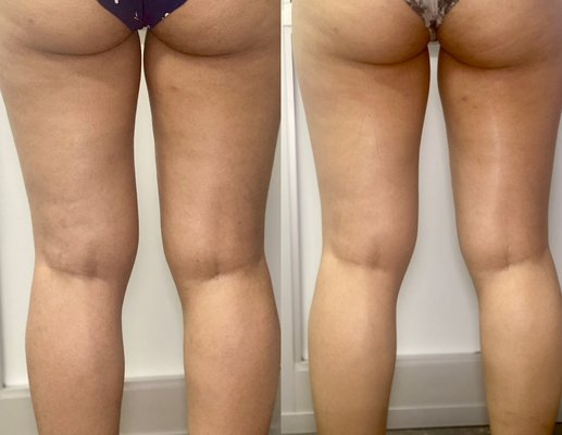 Before and After Pictures of Clients - These photos represent the results that were from immediately after the session and all treatments continue to refine for two weeks post treatment. Before and After Pictures of Clients - These photos represent the results that were from immediately after the session and all treatments continue to refine for two weeks post treatment.