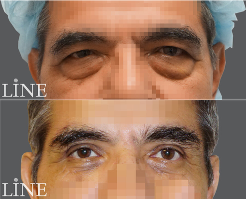Upper and lower blepharoplasty - Our doctors perform both upper and lower blepharoplasty in our Koreatown Los Angeles office and Irvine Orange County office. More before and after photos available on www.lineps.com and our Ktown office Yelp page https://www.yelp.com/biz/line-plastic-surgery-center-koreatown-los-angeles-3 Upper and lower blepharoplasty - Our doctors perform both upper and lower blepharoplasty in our Koreatown Los Angeles office and Irvine Orange County office. More before and after photos available on www.lineps.com and our Ktown office Yelp page https://www.yelp.com/biz/line-plastic-surgery-center-koreatown-los-angeles-3