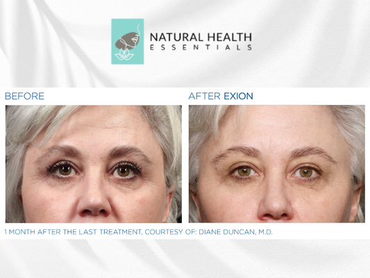 EXION - Experience next-level skin rejuvenation with EXION, a cutting-edge treatment that targets deep layers of skin using radiofrequency and AI-guided microneedling. Designed to stimulate natural collagen and hyaluronic acid production, EXION helps smooth, firm, and lift—all without downtime. Perfect for enhancing texture, reducing wrinkles, and achieving a refreshed, youthful glow. Discover visible results with this comfortable, non-invasive technology. EXION - Experience next-level skin rejuvenation with EXION, a cutting-edge treatment that targets deep layers of skin using radiofrequency and AI-guided microneedling. Designed to stimulate natural collagen and hyaluronic acid production, EXION helps smooth, firm, and lift—all without downtime. Perfect for enhancing texture, reducing wrinkles, and achieving a refreshed, youthful glow. Discover visible results with this comfortable, non-invasive technology.