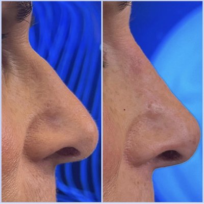 Non Surgical Rhinoplasty - Injectable Dermal fillers used to improve the appearance of the nose. Non Surgical Rhinoplasty - Injectable Dermal fillers used to improve the appearance of the nose.