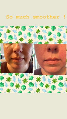 Lower face Juvederm filler - There are multiple uses for Juvederm filler. Marionette lines, jowls, cheeks, chin and jaw sculpting Lower face Juvederm filler - There are multiple uses for Juvederm filler. Marionette lines, jowls, cheeks, chin and jaw sculpting