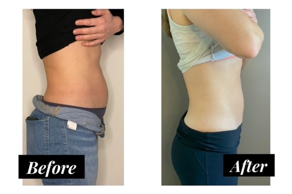 EmSculpt Neo-Body Sculpting - Transform your physique and boost your confidence with EmSculpt Neo, the revolutionary treatment available at Core Clinic. EmSculpt Neo is the perfect solution for those looking to melt fat permanently and tone muscles simultaneously. This cutting-edge technology combines radiofrequency (heat) and high- intensity focused electromagnetic energy (contract your muscles) to deliver unparalleled results, making it the ideal choice for anyone aiming for a more sculpted body and increased strength. EmSculpt Neo-Body Sculpting - Transform your physique and boost your confidence with EmSculpt Neo, the revolutionary treatment available at Core Clinic. EmSculpt Neo is the perfect solution for those looking to melt fat permanently and tone muscles simultaneously. This cutting-edge technology combines radiofrequency (heat) and high- intensity focused electromagnetic energy (contract your muscles) to deliver unparalleled results, making it the ideal choice for anyone aiming for a more sculpted body and increased strength.