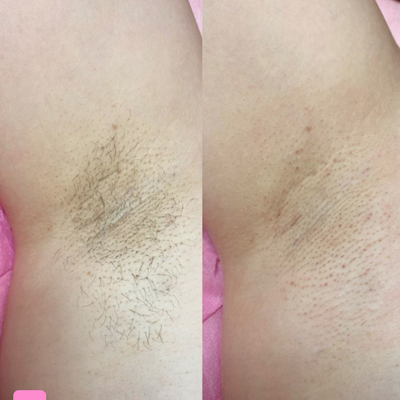 Underarm Waxing - Licensed esthetician specializing in Brazilians, brows, arm, and Vajacial. Schedule your appointment today! Underarm Waxing - Licensed esthetician specializing in Brazilians, brows, arm, and Vajacial. Schedule your appointment today!