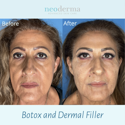 Dermal Fillers - Before and Afters - Dermal fillers are designed to replace volume loss in areas of the face usually due to aging. However, they are also used to enhance certain parts of the face for rejuvenation. Over time, your skin loses elasticity due to the natural process of aging, genetic and environmental factors like sun exposure can cause wrinkles and lines. With dermal fillers you can lift and volumize your cheeks, smoothen fine lines around the mouth, and enhance lip fullness to your desired volume. Discover a more youthful appearance with Juvederm or RHA Filler. Dermal Fillers - Before and Afters - Dermal fillers are designed to replace volume loss in areas of the face usually due to aging. However, they are also used to enhance certain parts of the face for rejuvenation. Over time, your skin loses elasticity due to the natural process of aging, genetic and environmental factors like sun exposure can cause wrinkles and lines. With dermal fillers you can lift and volumize your cheeks, smoothen fine lines around the mouth, and enhance lip fullness to your desired volume. Discover a more youthful appearance with Juvederm or RHA Filler.