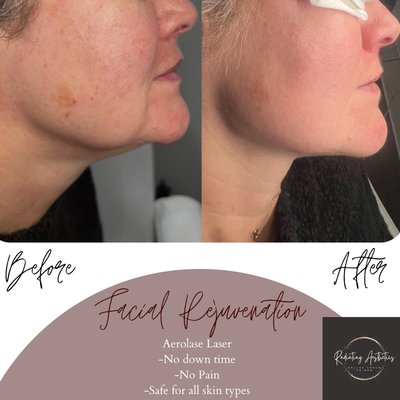 Unveiling the magic of Aerolase Laser for facial rejuvenation. Say hello to smaller pores, tighter skin & smoother skin with a radiant glow! - Aerolase laser, a cutting-edge technology for facial rejuvenation, utilizes advanced light-based energy to target skin imperfections. It promotes collagen production, reduces fine lines, and evens out skin tone. The non-invasive procedure offers a refreshing, youthful glow with minimal downtime, making it a popular choice for skin renewal. Unveiling the magic of Aerolase Laser for facial rejuvenation. Say hello to smaller pores, tighter skin & smoother skin with a radiant glow! - Aerolase laser, a cutting-edge technology for facial rejuvenation, utilizes advanced light-based energy to target skin imperfections. It promotes collagen production, reduces fine lines, and evens out skin tone. The non-invasive procedure offers a refreshing, youthful glow with minimal downtime, making it a popular choice for skin renewal.