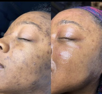 AHA/Enzyme Peels - A variety of Alpha hydroxy chemical peels , and enzymatic peels that work to address excess oils in the skin, acne, pigmentation concerns, aging, enlarged pores and texture. Gentle for all skin types including sensitive.  This peel is great for a more gentle peel with little to no downtime.  Includes 7 day post peel kit.