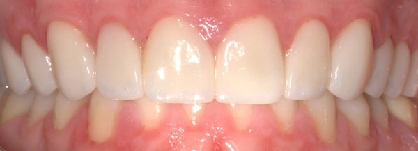 Invisalign & Porcelain Veneer - This patient presented with crowding, gaps, and misalignment in their front teeth, along with uneven tooth shapes that affected the overall smile symmetry.
We began treatment with Invisalign to gently and effectively align the teeth over time. After achieving proper alignment, we completed the transformation with a single porcelain veneer to enhance the shape and symmetry of the front tooth — all while maintaining a natural, balanced look.
✅ Before: Visible spacing, crowding, and asymmetry in the front teeth.
✅ After: A beautifully aligned and polished smile with natural contours and harmony.
This combination of orthodontic precision and cosmetic finesse delivered a dramatic yet natural result — and a very happy patient! Invisalign & Porcelain Veneer - This patient presented with crowding, gaps, and misalignment in their front teeth, along with uneven tooth shapes that affected the overall smile symmetry.
We began treatment with Invisalign to gently and effectively align the teeth over time. After achieving proper alignment, we completed the transformation with a single porcelain veneer to enhance the shape and symmetry of the front tooth — all while maintaining a natural, balanced look.
✅ Before: Visible spacing, crowding, and asymmetry in the front teeth.
✅ After: A beautifully aligned and polished smile with natural contours and harmony.
This combination of orthodontic precision and cosmetic finesse delivered a dramatic yet natural result — and a very happy patient!