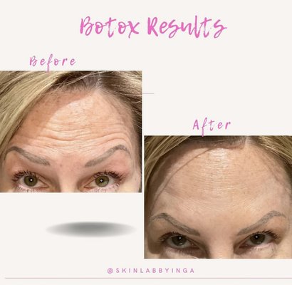 Forhead before and after - Before and after Botox