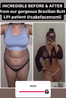 Patient Selfies - Check out some of our patient selfies! Schedule your consultation today! Patient Selfies - Check out some of our patient selfies! Schedule your consultation today!