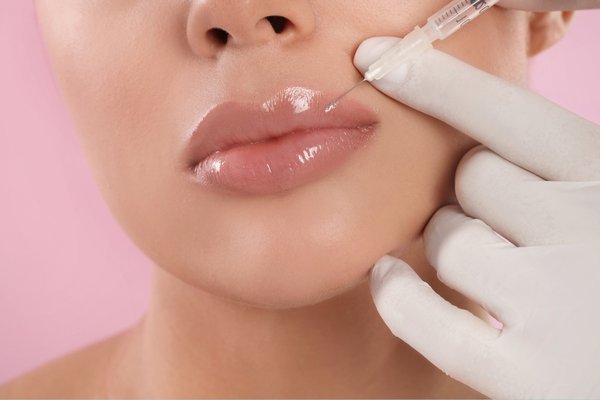 Lip Fillers at Spa Blue! - We offer a range of dermal fillers at Spa Blue, from Juvederm, Juvederm Voluma, Radiesse to Belotero Balance and Restylane! Our talented medical staff can discuss which method is best for you during your complimentary consultation! Lip Fillers at Spa Blue! - We offer a range of dermal fillers at Spa Blue, from Juvederm, Juvederm Voluma, Radiesse to Belotero Balance and Restylane! Our talented medical staff can discuss which method is best for you during your complimentary consultation!