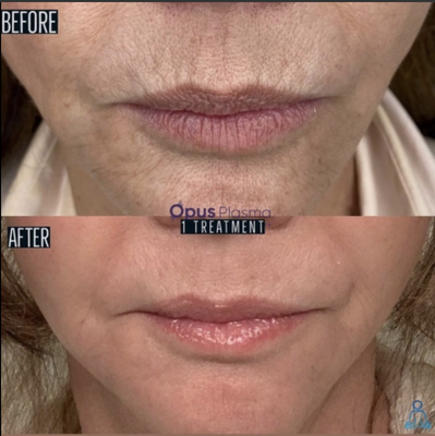 Opus Plasma Skin Tightening - Opus Plasma is the first fractional plasma technology to enter the skin resurfacing category to address superficial to complex textural and skin quality concerns. This treatment is customizable and can be controlled based on your desired result. It offers ablative results with non-ablative downtime. Opus Plasma Skin Tightening - Opus Plasma is the first fractional plasma technology to enter the skin resurfacing category to address superficial to complex textural and skin quality concerns. This treatment is customizable and can be controlled based on your desired result. It offers ablative results with non-ablative downtime.