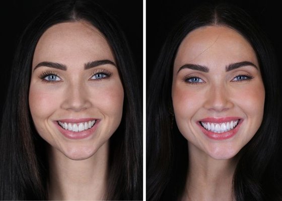 Cosmetic Dentistry - Whether you’re in need of a single veneer or an entire smile makeover, we have the technical expertise and skill necessary to give you the results you desire.

Invisalign
As an expert in Invisalign® aligners, Dr. Matian will straighten your teeth with this discreet, modern method.

Tooth Whitening
Often, making your teeth just a few shades whiter will make your smile infinitely brighter. Come see our tooth whitening experts.

Porcelain Veneers
Veneers are one of the most popular dental products available. We offer several excellent options for patients looking to restore their smile.

BioThin Veneers
BioThin veneers is a method we administer to deliver beautiful veneers with the least drilling possible. 
They are made of very thin, high quality porcelain, and can be applied without any disruption of the natural tooth structure.