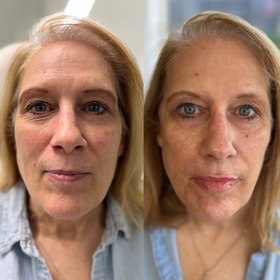 Botox & Dermal Fillers - Botox and Fillers