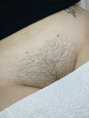 Before & After-Brazilian wax - Before and after results of Brazilian waxes. Achieved in 15 minutes or less! Before & After-Brazilian wax - Before and after results of Brazilian waxes. Achieved in 15 minutes or less!
