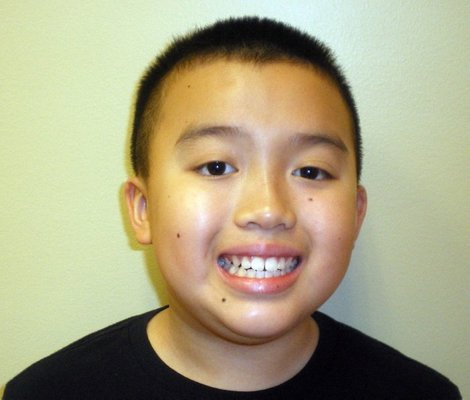 HealthyStart® Bite & Alignment Treatment - This pediatric case shows progress approximately two-thirds of the way through a HealthyStart® treatment plan. At the initial evaluation, the patient presented with an overjet, open bite, and Class II bite relationship, along with reported concerns including mouth breathing, snoring, restless sleep, teeth grinding, and other nighttime symptoms.
The progress photos show changes in dental alignment, bite relationship, and jaw development during treatment. Treatment is still in progress, and final results have not yet been evaluated. HealthyStart® Bite & Alignment Treatment - This pediatric case shows progress approximately two-thirds of the way through a HealthyStart® treatment plan. At the initial evaluation, the patient presented with an overjet, open bite, and Class II bite relationship, along with reported concerns including mouth breathing, snoring, restless sleep, teeth grinding, and other nighttime symptoms.
The progress photos show changes in dental alignment, bite relationship, and jaw development during treatment. Treatment is still in progress, and final results have not yet been evaluated.