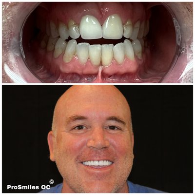 Cosmetic (Veneer/Crowns) - While we do a variety of procedures in our office, this project showcases a few of our veneer cases. In each and every patient, we see a smile that's just waiting to come out and Dr. Ho was able to give them the smile they've always dreamed of. Come see what your smile can say about you! Cosmetic (Veneer/Crowns) - While we do a variety of procedures in our office, this project showcases a few of our veneer cases. In each and every patient, we see a smile that's just waiting to come out and Dr. Ho was able to give them the smile they've always dreamed of. Come see what your smile can say about you!