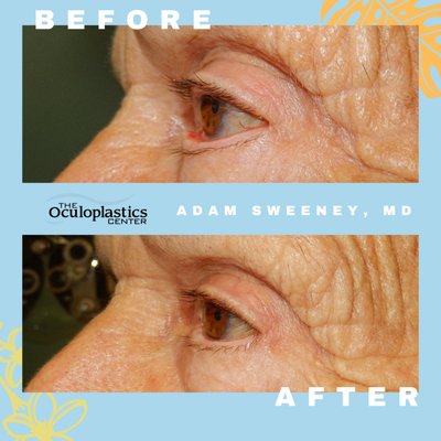 Eyelid surgery - This patient had irritation and redness of the left eye from lower lid ectropion. Ectropion is the outward rotation or out-turning of the eyelid. Because the lids protect the eye and help lubricate the eyelids, ectropion may compromise the health of the eye and lead to significant dryness or exposure of the eye. Surgery to correct ectropion involves tightening of the loose tendons of the lower lid and surgically rotating the eyelid to the correct orientation. If your eyelids need a little TLC, call our office at 808-599-4755 to set up an evaluation. ⁠