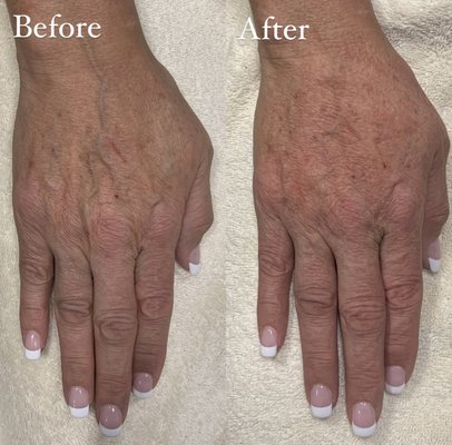 Hand Rejuvenation - We can help give the back of your hands a more youthful appearance by addressing volume loss by using dermal fillers, or reducing sun spots/ age spots with an IPL laser. Hand Rejuvenation - We can help give the back of your hands a more youthful appearance by addressing volume loss by using dermal fillers, or reducing sun spots/ age spots with an IPL laser.