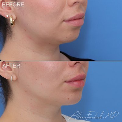 Chin Implant - A chin implant is a surgical procedure that enhances the size of your chin. This procedure can help add definition and balance to your chin and jawline.