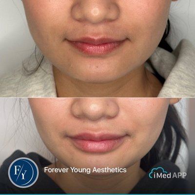 Lip Filler Enhancements - The most typical product for dermal filler is a colorless hyaluronic acid that is designed to be injected into facial tissue to smooth wrinkles and plump folds. Hyaluronic acid is found naturally in all living organisms, and has the same chemical structure in all species and tissues. In the skin, hyaluronic acid binds water to add volume and pliability. As we age, our skin loses its ability to produce hyaluronic acid. Lip Filler Enhancements - The most typical product for dermal filler is a colorless hyaluronic acid that is designed to be injected into facial tissue to smooth wrinkles and plump folds. Hyaluronic acid is found naturally in all living organisms, and has the same chemical structure in all species and tissues. In the skin, hyaluronic acid binds water to add volume and pliability. As we age, our skin loses its ability to produce hyaluronic acid.