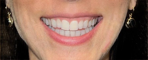 Before and After - Botox can treat a gummy smile and add lip height with a lip flip. A lip flip is a beautiful alternative for anyone still determining if they are ready for lip fillers, or it can be done in addition to lip fillers for a more defined look. Before and After - Botox can treat a gummy smile and add lip height with a lip flip. A lip flip is a beautiful alternative for anyone still determining if they are ready for lip fillers, or it can be done in addition to lip fillers for a more defined look.