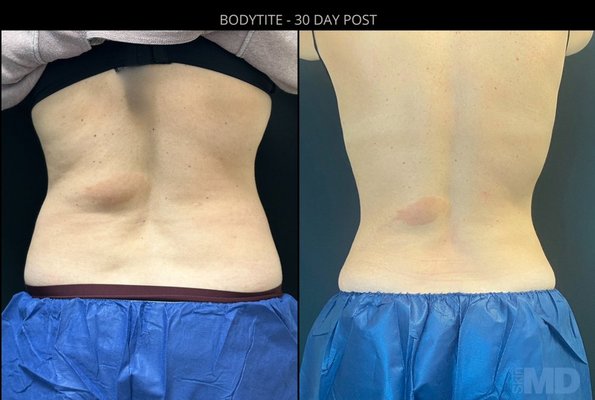 BodyTite - BodyTite is an advanced body contouring and refinement procedure that allows patients to avoid extensive or excisional surgery with or without liposuction.
BodyTite can be performed on any place in your body that exhibits skin laxity such as:
Neck
Chin
Upper Arms (Batwings)
Abdominal area
Hips (love handles or muffin top included)
Thighs
Knees
Buttocks
Bra line
Male Breasts BodyTite - BodyTite is an advanced body contouring and refinement procedure that allows patients to avoid extensive or excisional surgery with or without liposuction.
BodyTite can be performed on any place in your body that exhibits skin laxity such as:
Neck
Chin
Upper Arms (Batwings)
Abdominal area
Hips (love handles or muffin top included)
Thighs
Knees
Buttocks
Bra line
Male Breasts