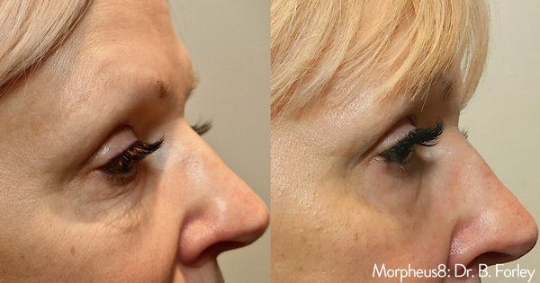 Morpheus8 - We cannot get enough of this skin tightening, collagen-building treatment. Who doesn't want tighter, brighter, healthier skin!? 

Morpheus8 is a minimally invasive (no downtime!) microneedling with radiofrequency treatment that is safe & effective for all skin types! 

Morpheus8 truly delivers on all skin issues; improving:
skin tone
texture
fine lines 
wrinkles
scarring
acne
loose skin

Book a consultation to see if it is right for you!