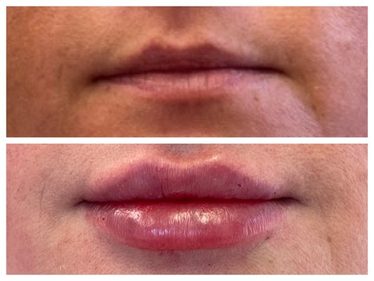 Before and after lip injections - These lovely patients wanted to enhance their lips. We injected a soft hyaluronic acid filler to give volume and hydration. We all couldn't be more pleased! Before and after lip injections - These lovely patients wanted to enhance their lips. We injected a soft hyaluronic acid filler to give volume and hydration. We all couldn't be more pleased!