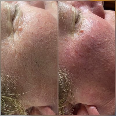 Acne Facial - The Acne Facial will be customized to fit your skin needs and skin type plus target acne and breakouts. It includes a deep-cleansing, exfoliation, extractions, modalities and a mask.