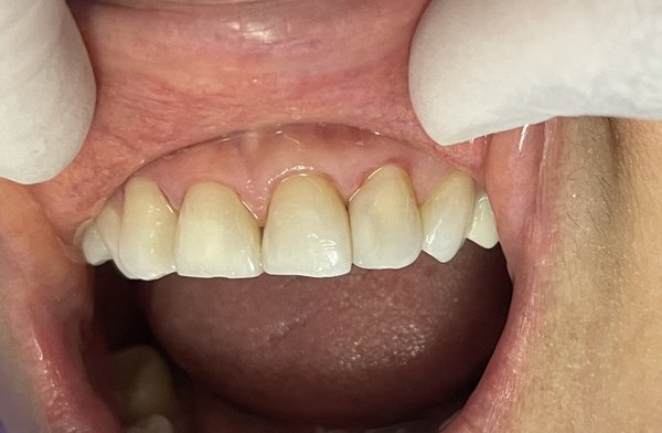 Dental Bonding vs. Veneer - Both dental bonding and veneers are popular cosmetic dental treatments used to improve the appearance of teeth.  

Which One is Right for You?

	Choose Dental Bonding if:
	•	You have minor cosmetic concerns or need a quick, affordable solution.
	•	You prefer a less invasive procedure.

	Choose Veneers if:
	•	You want a long-lasting and more dramatic smile transformation.
	•	You’re addressing severe discoloration, misalignment, or damage.