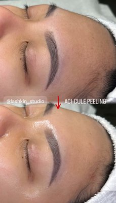 Aci-Cule Peeling - Acicule Peeling is a specialized treatment that combines micro-needles (spicules) with acid components such as AHA, BHA, and PHA. It gently removes dead skin cells and impurities, leaving your skin clearer and smoother. The micro-needles provide gentle stimulation to help boost collagen production, while the acids support skin tone improvement and overall rejuvenation. Aci-Cule Peeling - Acicule Peeling is a specialized treatment that combines micro-needles (spicules) with acid components such as AHA, BHA, and PHA. It gently removes dead skin cells and impurities, leaving your skin clearer and smoother. The micro-needles provide gentle stimulation to help boost collagen production, while the acids support skin tone improvement and overall rejuvenation.