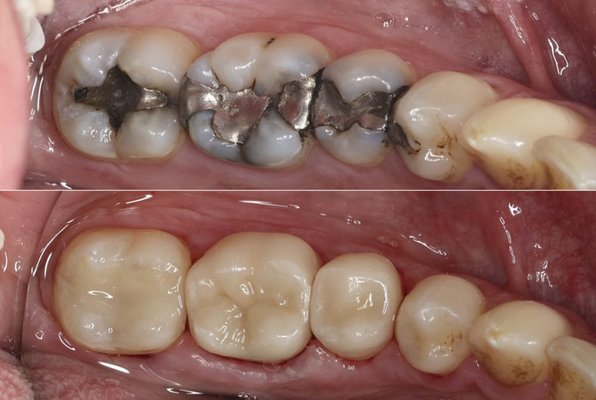 Replacing Defective Silver Fillings with Tooth Colored Composite - Say goodbye to silver fillings! ✨ We replaced old amalgam fillings with natural-looking, tooth-colored composite for a healthier, more seamless smile. Ready to upgrade your smile? Book your appointment today! 😁 #ToothColoredFillings #SmileUpgrade Replacing Defective Silver Fillings with Tooth Colored Composite - Say goodbye to silver fillings! ✨ We replaced old amalgam fillings with natural-looking, tooth-colored composite for a healthier, more seamless smile. Ready to upgrade your smile? Book your appointment today! 😁 #ToothColoredFillings #SmileUpgrade